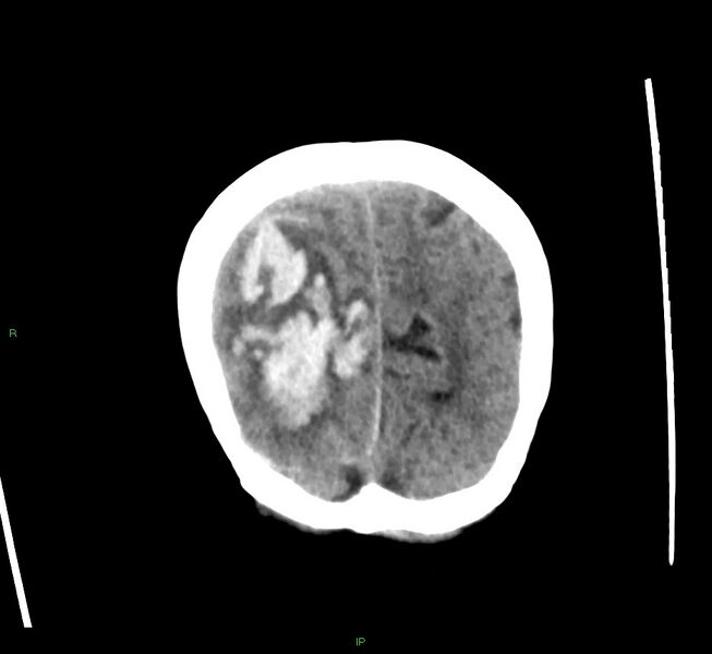 File:Cerebral amyloid angiopathy-associated lobar intracerebral hemorrhage (Radiopaedia 58563-65727 Coronal non-contrast 14).jpg