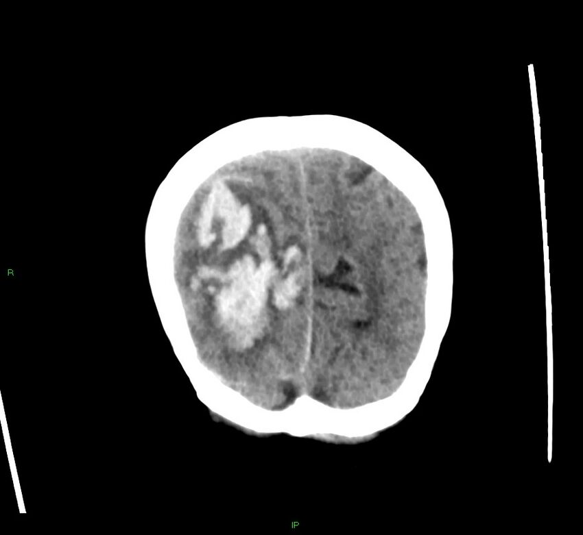 Cerebral amyloid angiopathy-associated lobar intracerebral hemorrhage (Radiopaedia 58563-65727 Coronal non-contrast 14).jpg
