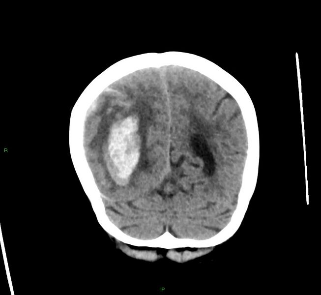 File:Cerebral amyloid angiopathy-associated lobar intracerebral hemorrhage (Radiopaedia 58563-65727 Coronal non-contrast 19).jpg