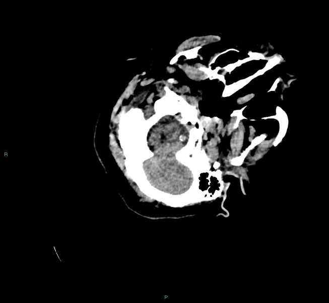 File:Cerebral amyloid angiopathy-associated lobar intracerebral hemorrhage (Radiopaedia 58757-65979 Axial non-contrast 19).jpg