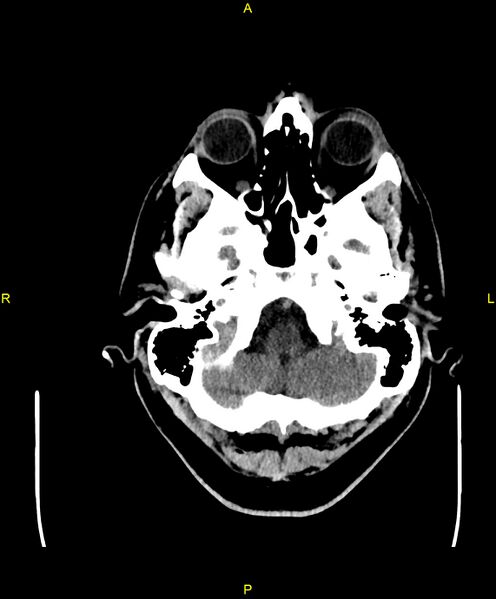 File:Cerebral autosomal dominant arteriopathy with subcortical infarcts and leukoencephalopathy (CADASIL) (Radiopaedia 86108-102051 Axial non-contrast 14).jpg
