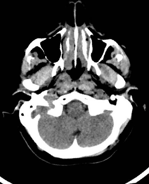 File:Cerebral edema due to severe hyponatremia (Radiopaedia 89826-106938 Axial non-contrast 17).jpg