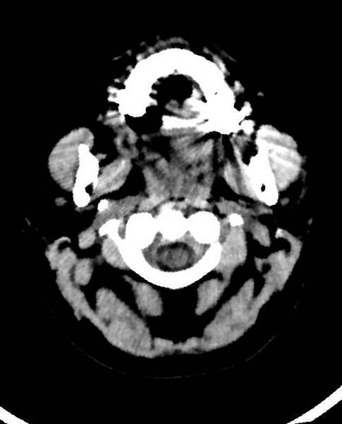 File:Cerebral edema due to severe hyponatremia (Radiopaedia 89826-106938 Axial non-contrast 3).jpg