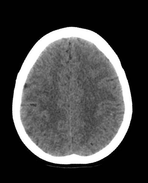 File:Cerebral edema due to severe hyponatremia (Radiopaedia 89826-106938 Axial non-contrast 77).jpg