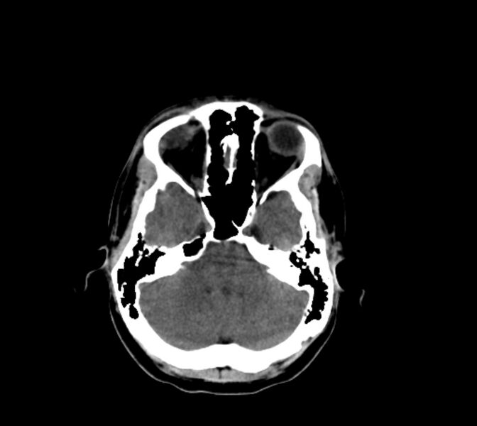File:Cerebral fat embolism (Radiopaedia 37510-39362 Axial non-contrast 10).jpg
