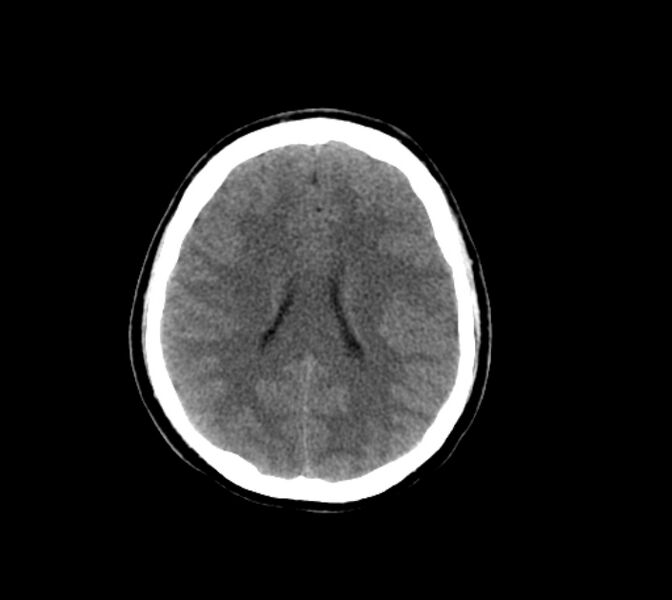 File:Cerebral fat embolism (Radiopaedia 37510-39362 Axial non-contrast 22).jpg