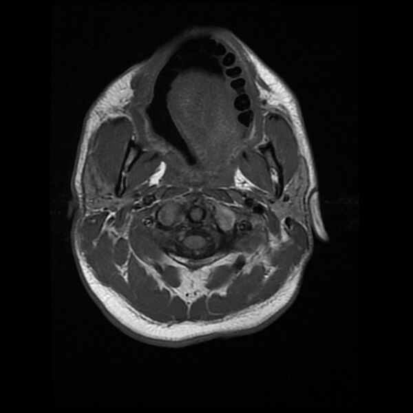 File:Cerebral fat embolism (Radiopaedia 37510-39363 Axial T1 1).jpg