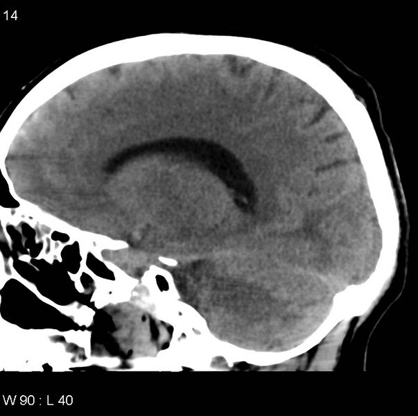 File:Cerebral hemorrhagic contusion with subdural and subarachnoid hemorrhage (Radiopaedia 10680-11146 C 7).jpg