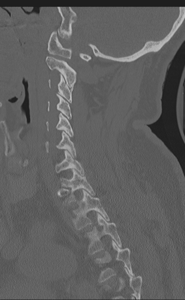 File:Cervical canal stenosis - OPLL and osteophytes (Radiopaedia 47329-51910 Sagittal bone window 27).png
