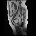 Cervical carcinoma (Radiopaedia 78847-91705 Sagittal T2 1).jpg