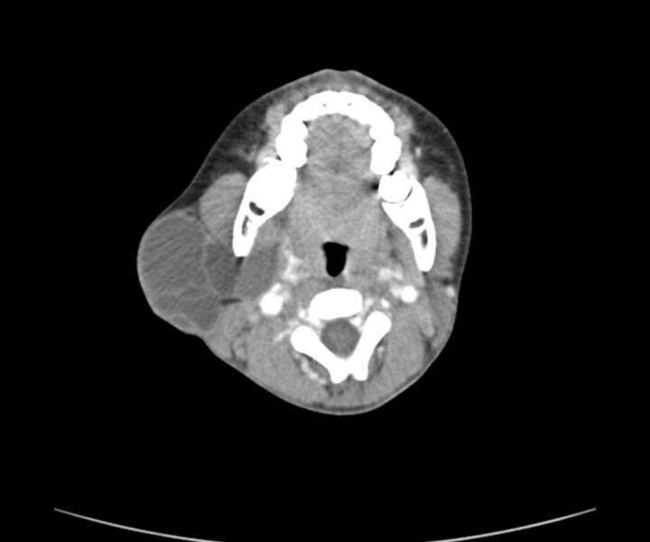 File:Cervical cystic lymphangioma (Radiopaedia 63655-72332 Axial + contrast 11).jpg