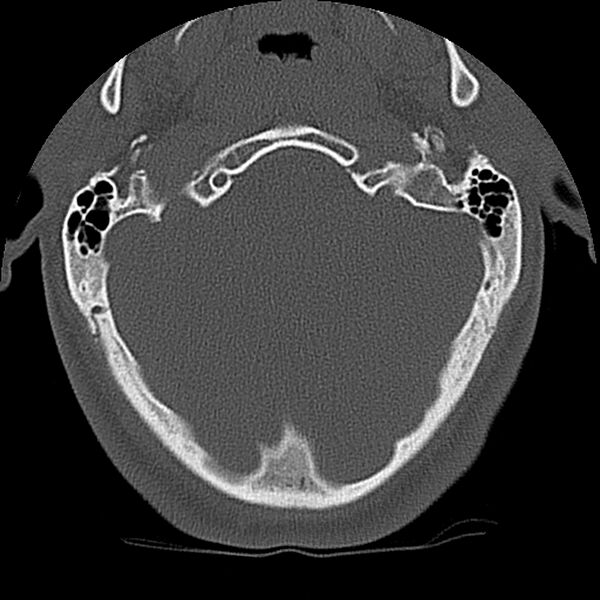 File:Cervical flexion teardrop fracture with cord hemorrhage (Radiopaedia 32497-33454 Axial bone window 5).jpg