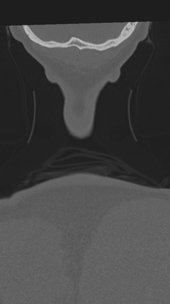 File:Cervical intercalary bone (Radiopaedia 35211-36748 Coronal bone window 85).png