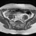 Cesarian section scar endometriosis (Radiopaedia 66520-75799 Axial T1 1).jpg