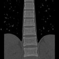 Chance fracture (Radiopaedia 36521-38081 Coronal bone window 24).jpg
