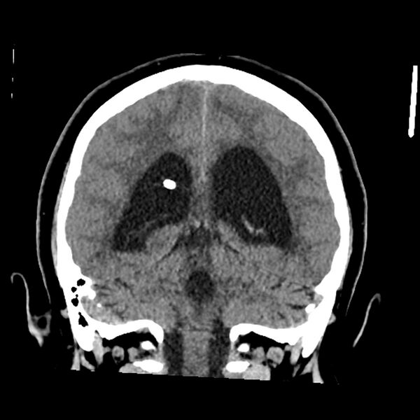 File:Chiasmatic-hypothalamic juvenile pilocytic astrocytoma (Radiopaedia 78533-91237 Coronal non-contrast 46).jpg