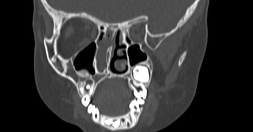 Choanal atresia (Radiopaedia 51295-56972 Coronal bone window 48).jpg