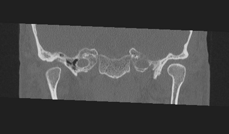 File:Cholesteatoma (Radiopaedia 10742-11203 Coronal bone window 1).jpg