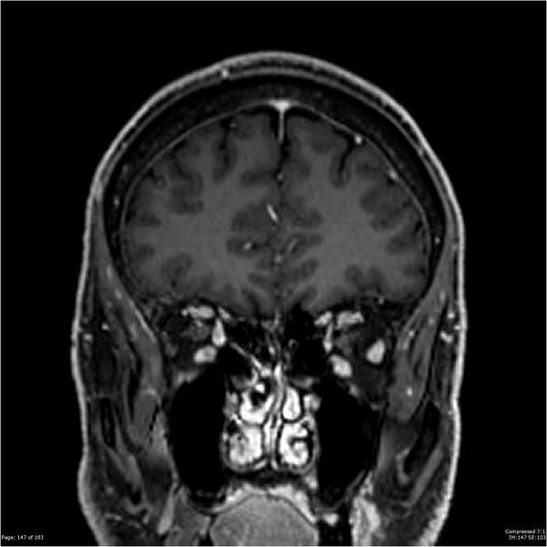 File:Chondrosarcoma of skull base- grade II (Radiopaedia 40948-43654 Coronal T1 C+ 58).jpg