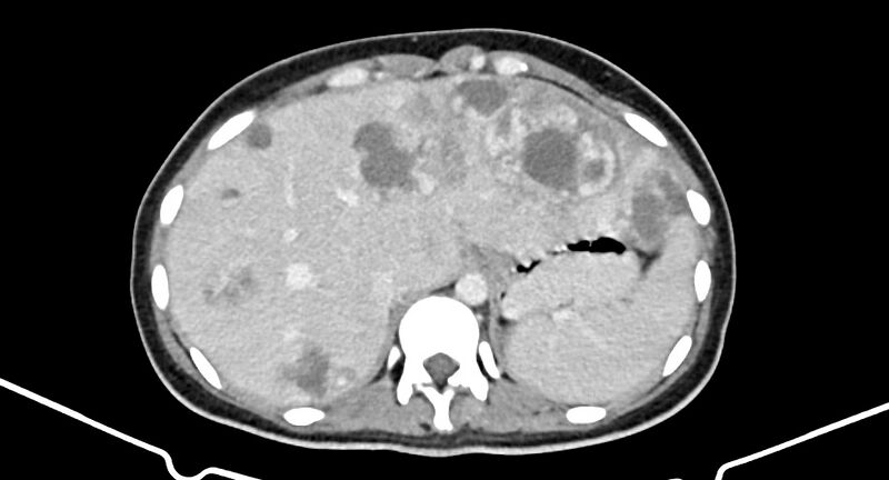 File:Choriocarcinoma liver metastases (Radiopaedia 74768-85766 A 49).jpg