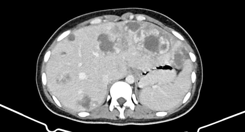 Choriocarcinoma liver metastases (Radiopaedia 74768-85766 A 49).jpg