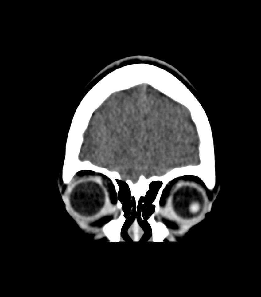 Choroid plexus carcinoma (Radiopaedia 91013-108552 Coronal non-contrast 11).jpg