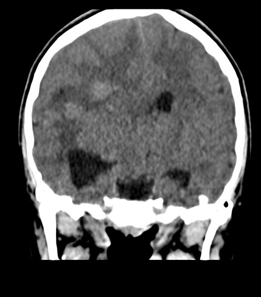 File:Choroid plexus carcinoma (Radiopaedia 91013-108552 Coronal non-contrast 43).jpg