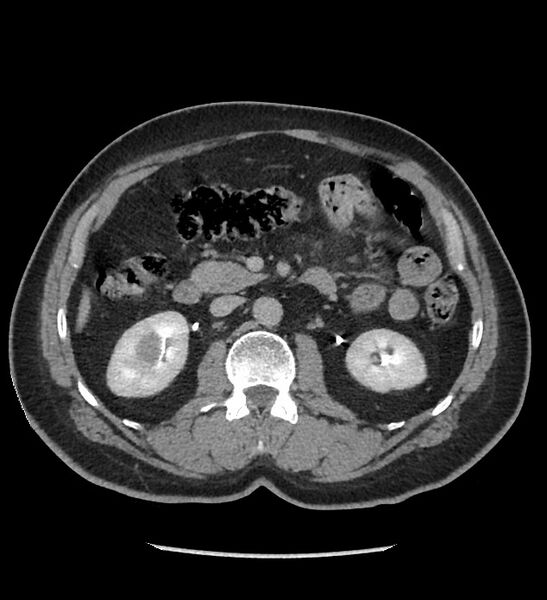 File:Chromophobe renal cell carcinoma (Radiopaedia 86879-103083 D 61).jpg
