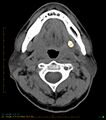 Chronic Submandibular sialolithiasis (Radiopaedia 16880-16606 Axial non-contrast 13).jpg