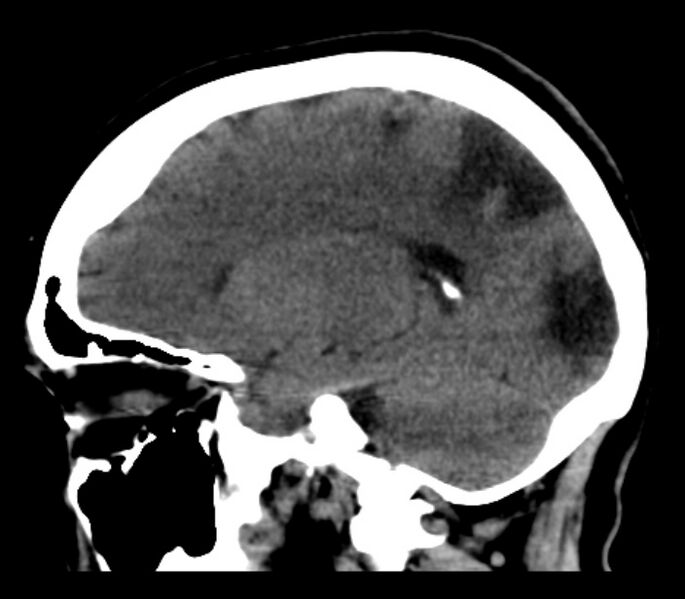 File:Chronic bilateral occipital lobe infarcts (Radiopaedia 31276-31996 C 16).jpg