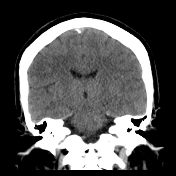 File:Chronic bilateral occipital lobe infarcts (Radiopaedia 31276-31996 Coronal non-contrast 28).jpg