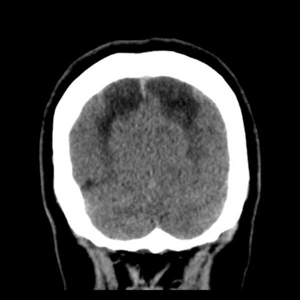 File:Chronic bilateral occipital lobe infarcts (Radiopaedia 31276-31996 Coronal non-contrast 40).jpg