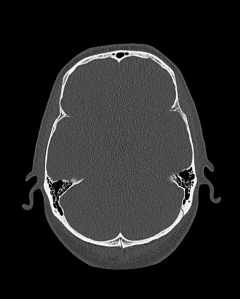 File:Chronic maxillary sinusitis caused by a foreign body (Radiopaedia 58521-65676 Axial bone window 298).jpg