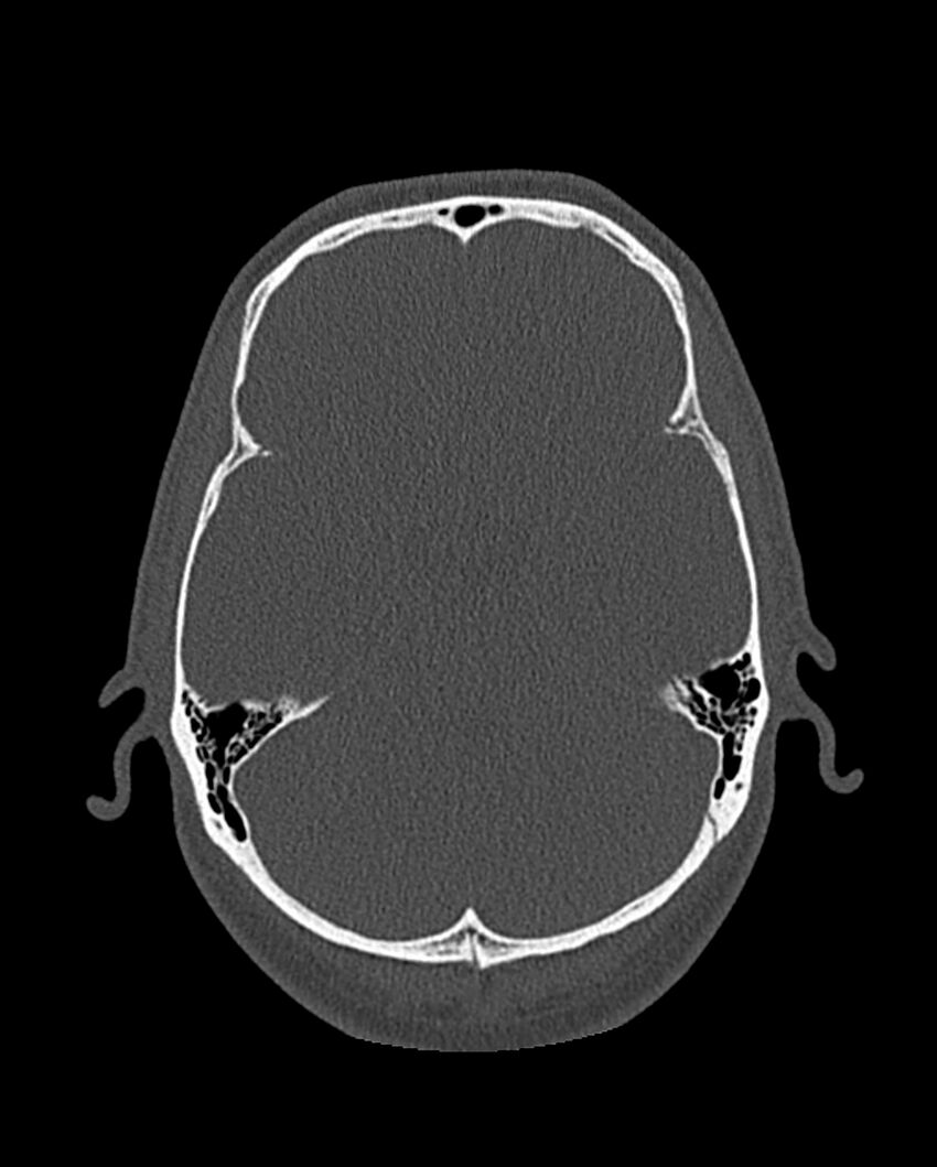 Chronic maxillary sinusitis caused by a foreign body (Radiopaedia 58521-65676 Axial bone window 298).jpg