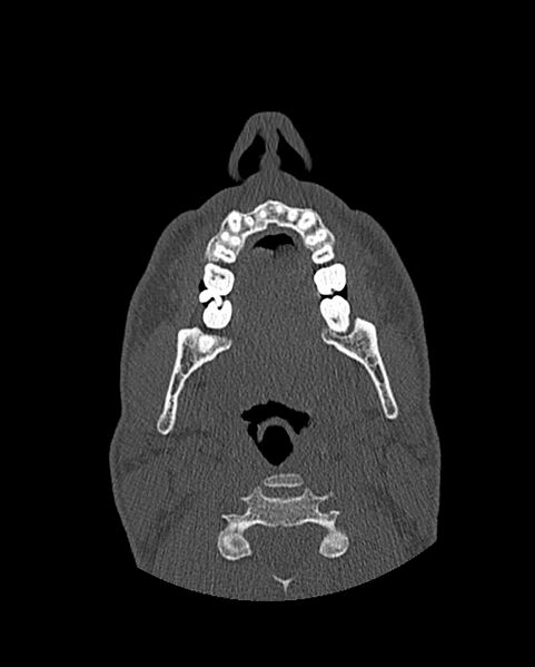 File:Chronic maxillary sinusitis caused by a foreign body (Radiopaedia 58521-65676 Axial bone window 3).jpg