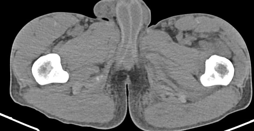 Chronic osteomyelitis (with sequestrum) (Radiopaedia 74813-85822 D 59).jpg