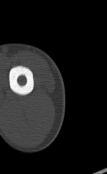 File:Chronic osteomyelitis of the distal humerus (Radiopaedia 78351-90971 Axial bone window 6).jpg