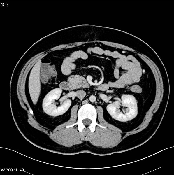 File:Chronic pancreatitis and pseudocysts (Radiopaedia 6724-7935 D 12).jpg
