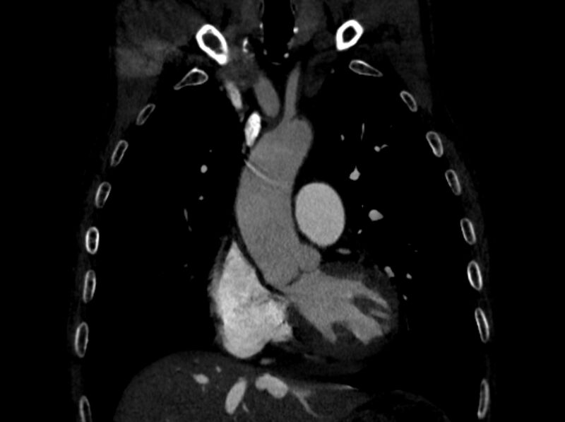 File:Chronic pulmonary embolism (Radiopaedia 91241-108843 A 34).jpg