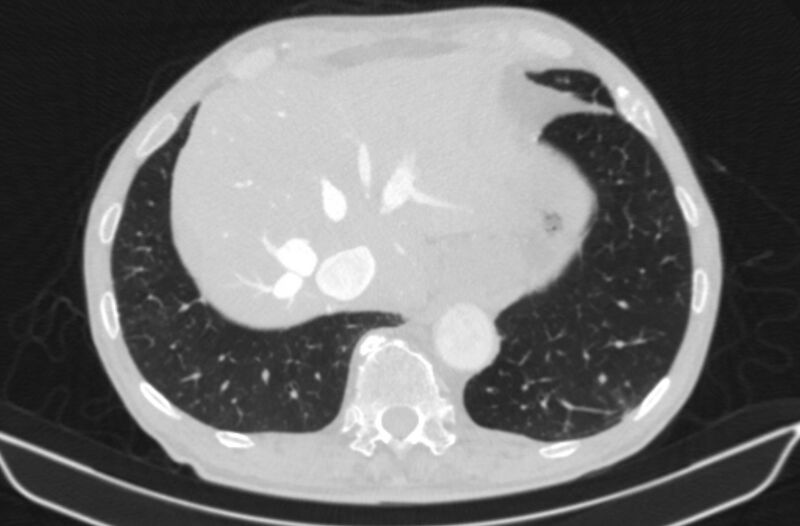 File:Chronic pulmonary embolism (Radiopaedia 91241-108843 Axial lung window 80).jpg