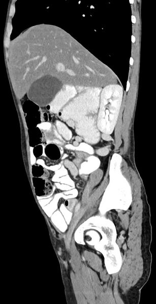 File:Chronic small bowel volvulus (Radiopaedia 75224-86322 C 101).jpg