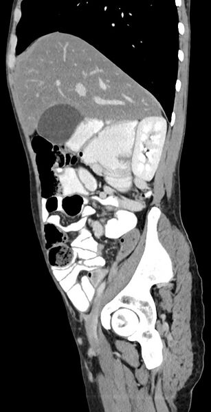 File:Chronic small bowel volvulus (Radiopaedia 75224-86322 C 103).jpg