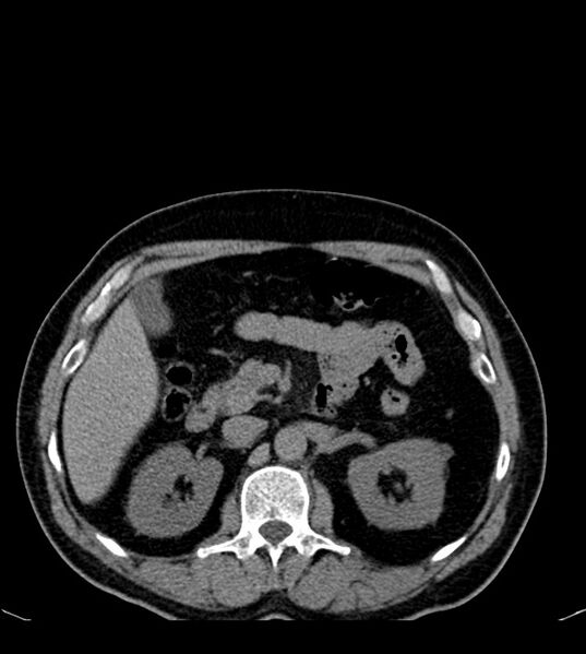 File:Clear cell renal cell carcinoma (Radiopaedia 85006-100539 Axial non-contrast 33).jpg