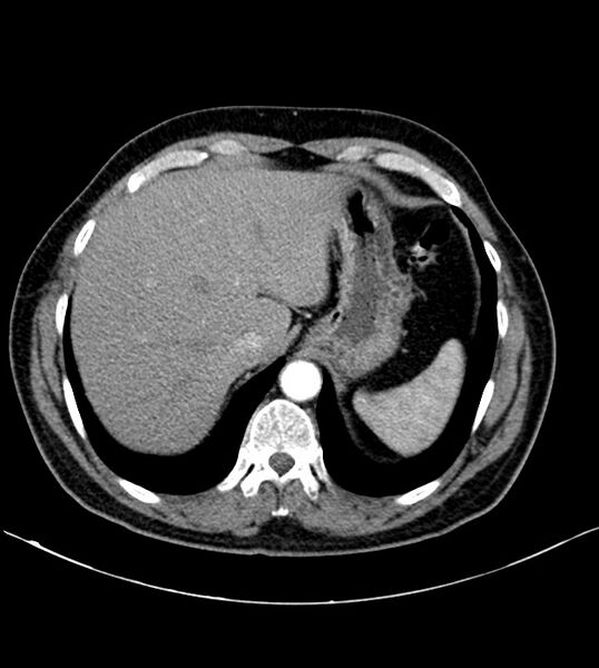 File:Clear cell renal cell carcinoma (Radiopaedia 85006-100539 B 20).jpg