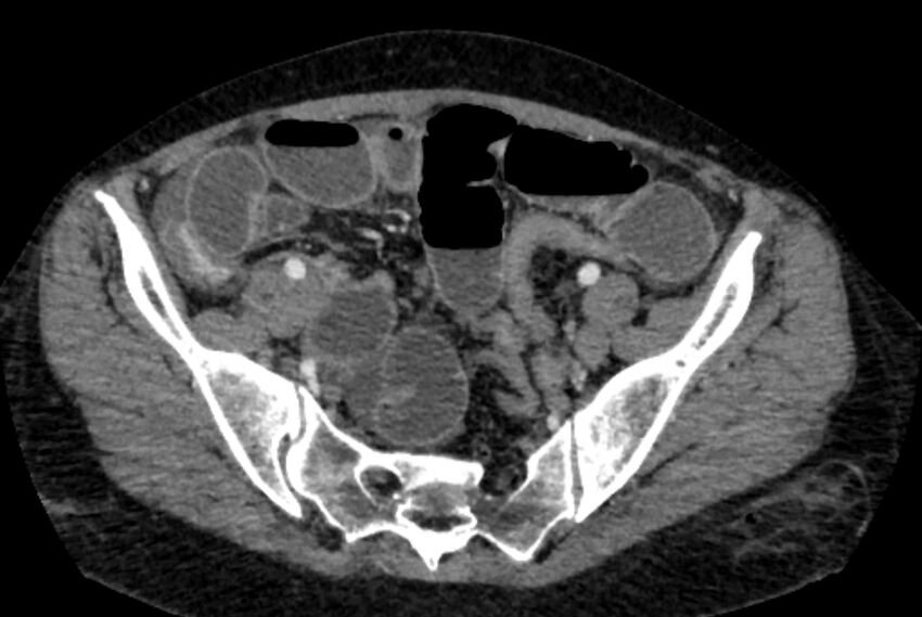 Closed loop small bowel obstruction (Radiopaedia 71211-81508 A 122).jpg