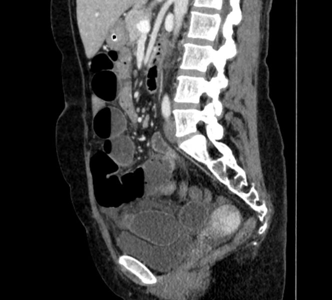 File:Closed loop small bowel obstruction (Radiopaedia 71211-81508 C 83).jpg