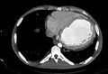 Coarctation of aorta with aortic valve stenosis (Radiopaedia 70463-80574 A 166).jpg