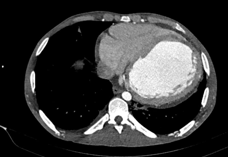 File:Coarctation of aorta with aortic valve stenosis (Radiopaedia 70463-80574 A 166).jpg