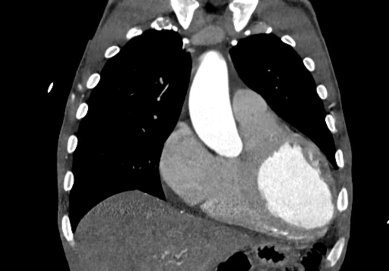 File:Coarctation of aorta with aortic valve stenosis (Radiopaedia 70463-80574 C 60).jpg