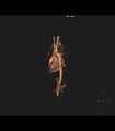 Coarctation of the aorta (Radiopaedia 43373-46729 3D reconstruction 12).jpg
